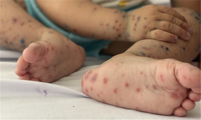 Hơn 80.700 ca mắc, 21 ca tử vong do tay chân miệng, dấu hiệu bệnh chuyển nặng cần biết