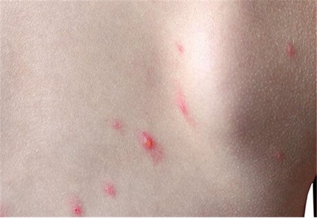 Ghi nhận 2 ca mắc bệnh đậu mùa khỉ tại TPHCM