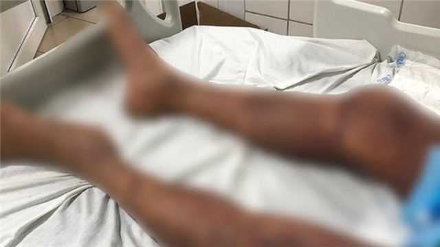 Hà Nội ghi nhận 2 trường hợp tử vong vì mắc liên cầu lợn