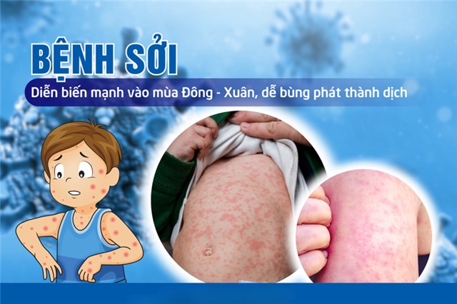 Thành phố Uông Bí chỉ đạo tăng cường phòng chống bệnh sởi