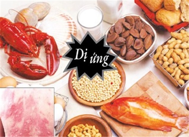 Người bị dị ứng thực phẩm có thêm thuốc điều trị mới