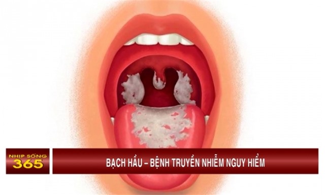 Bạch hầu – Bệnh truyền nhiễm nguy hiểm