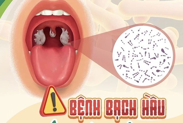 Không để lây lan, bùng phát bệnh bạch hầu 