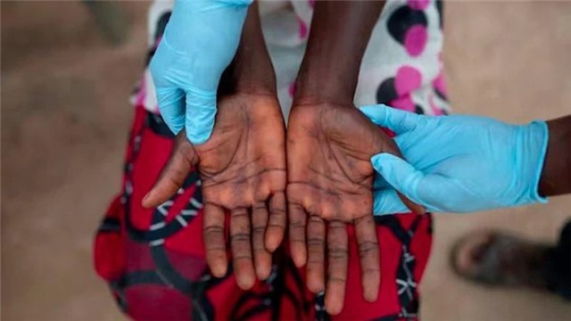 Liên minh châu Phi ban bố tình trạng khẩn cấp y tế công cộng về bệnh đậu mùa khỉ