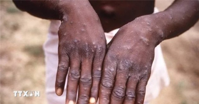 WHO ban bố tình trạng khẩn cấp về sức khỏe vì đậu mùa khỉ