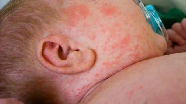 Thành phố Hồ Chí Minh công bố dịch sởi: Những điều cần biết và lưu ý