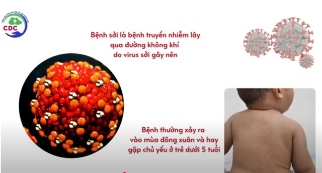 Khuyến cáo phòng chống bệnh Sởi
