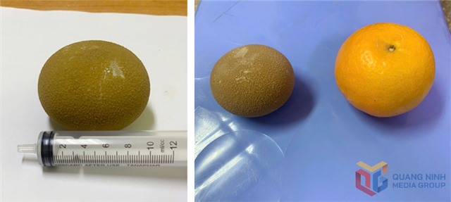 Phẫu thuật lấy sỏi bàng quang lớn như quả cam ra khỏi cơ thể người bệnh