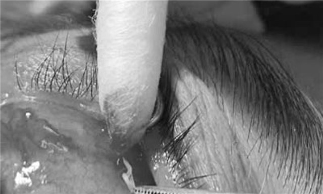 Một bệnh nhân bị viêm thượng củng mạc mắt do giun sán chó mèo ký sinh trong mắt