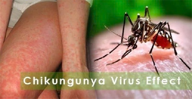 Chikungunya dễ gây tàn phế và nhầm lẫn với sốt xuất huyết